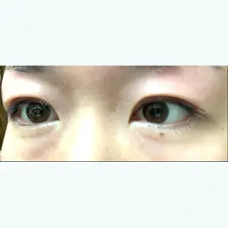 2日目の経過画像（1枚目）