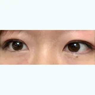 2日目の経過画像（1枚目）