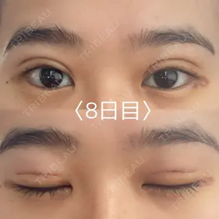 8日目の経過画像（1枚目）