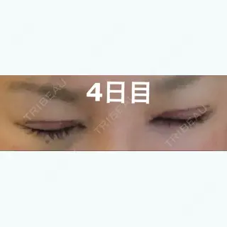 4日目の経過画像（2枚目）