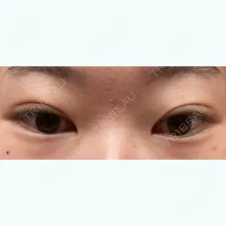 4日目の経過画像（1枚目）