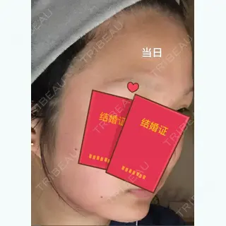 0日目の経過画像（2枚目）