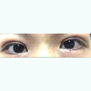 0日目の経過画像（1枚目）