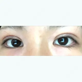 1日目の経過画像（1枚目）