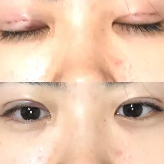 1日目の経過画像（1枚目）