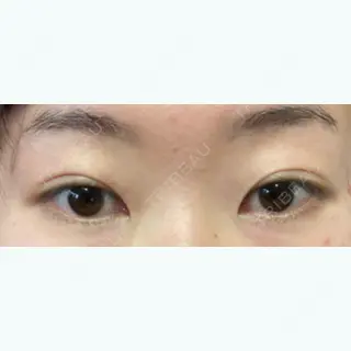 6日目の経過画像（1枚目）