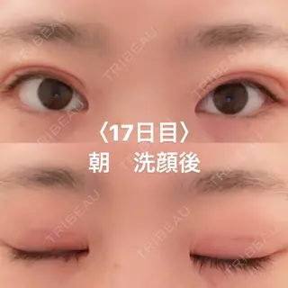 17日目の経過画像（1枚目）