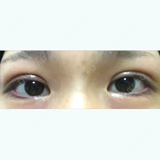 1日目の経過画像（1枚目）