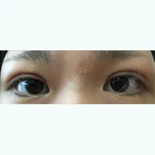 2日目の経過画像（1枚目）