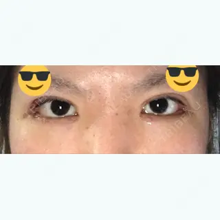 9日目の経過画像（1枚目）