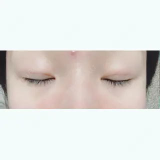 3日目の経過画像（2枚目）