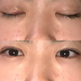3日目の経過画像（1枚目）