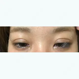 13日目の経過画像（2枚目）