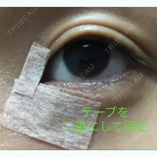 25日目の経過画像（3枚目）