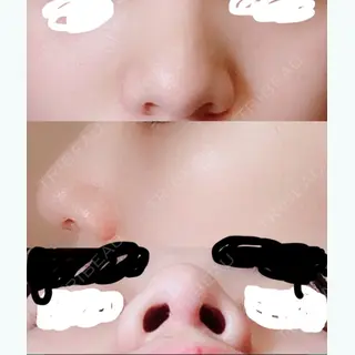 78日目の経過画像（1枚目）