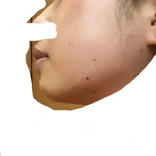 11日目の経過画像（2枚目）