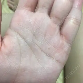 26日目の経過画像（1枚目）