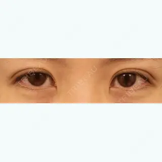 15日目の経過画像（1枚目）