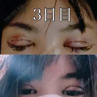 2日目の経過画像（1枚目）