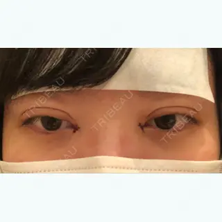 0日目の経過画像（1枚目）