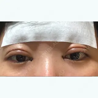 1日目の経過画像（1枚目）