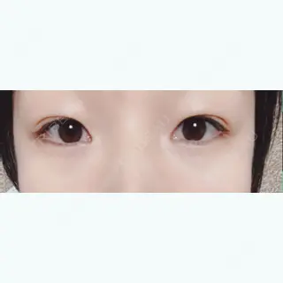 6日目の経過画像（1枚目）