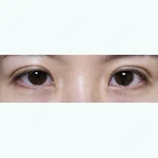 17日目の経過画像（1枚目）