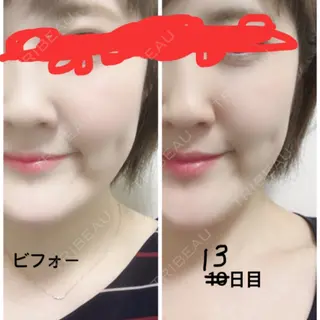 13日目の経過画像（1枚目）