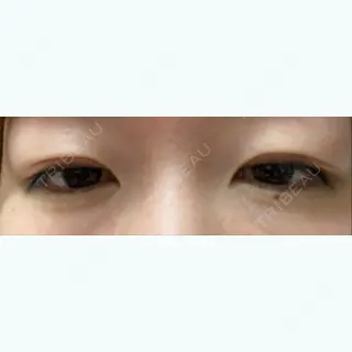 26日目の経過画像（2枚目）