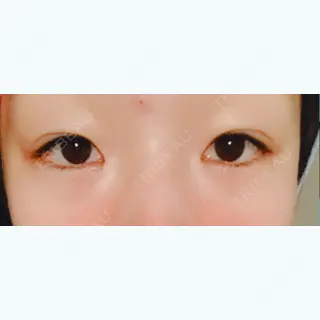 8日目の経過画像（1枚目）