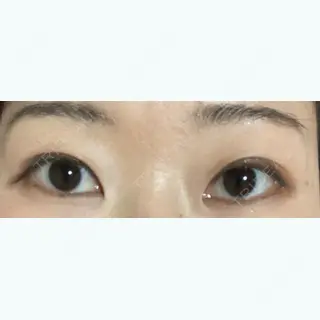 31日目の経過画像（1枚目）