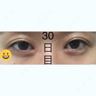 30日目の経過画像（1枚目）