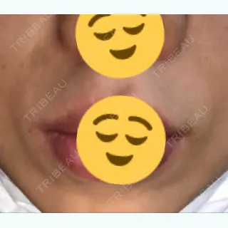 4日目の経過画像（1枚目）