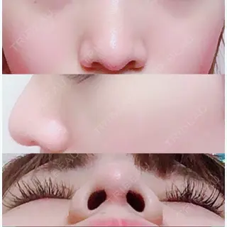 83日目の経過画像（1枚目）