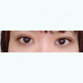 5日目の経過画像（1枚目）