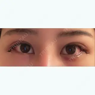 5日目の経過画像（1枚目）
