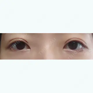 31日目の経過画像（1枚目）