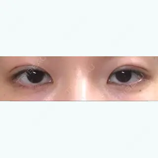 0日目の経過画像（2枚目）