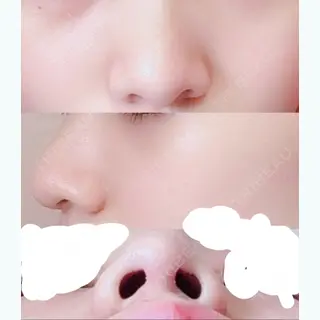 86日目の経過画像（1枚目）
