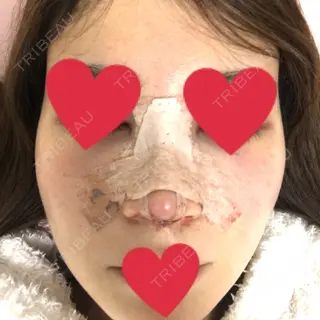 1日目の経過画像（1枚目）