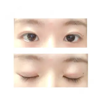 11日目の経過画像（1枚目）