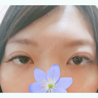 0日目の経過画像（1枚目）