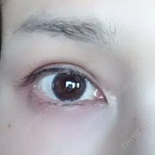 338日目の経過画像（1枚目）