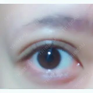 12日目の経過画像（2枚目）