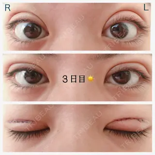3日目の経過画像（1枚目）