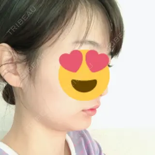 2日目の経過画像（3枚目）