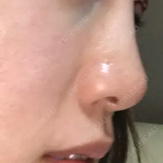 0日目の経過画像（1枚目）