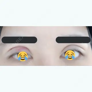 0日目の経過画像（1枚目）