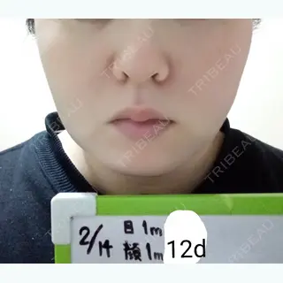 42日目の経過画像（1枚目）