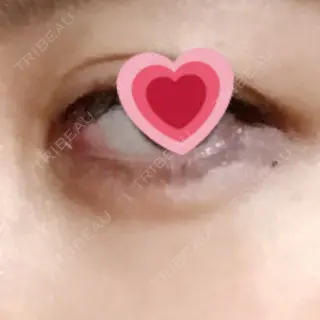 1日目の経過画像（3枚目）